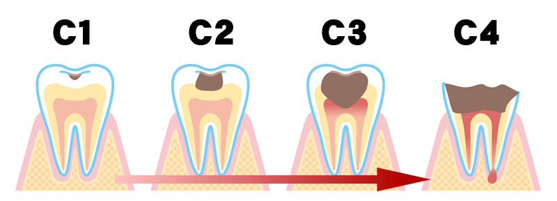 虫歯の進行